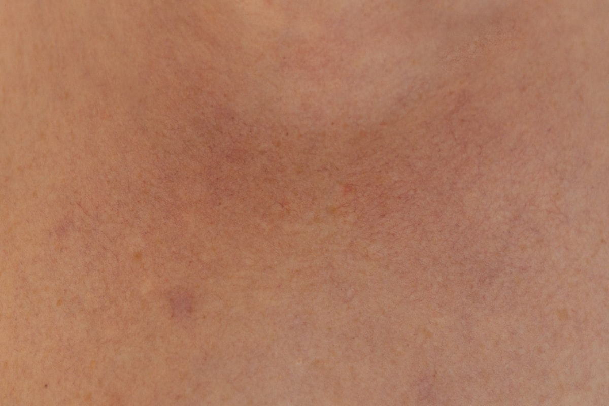 Scalpflaketreatment projekt